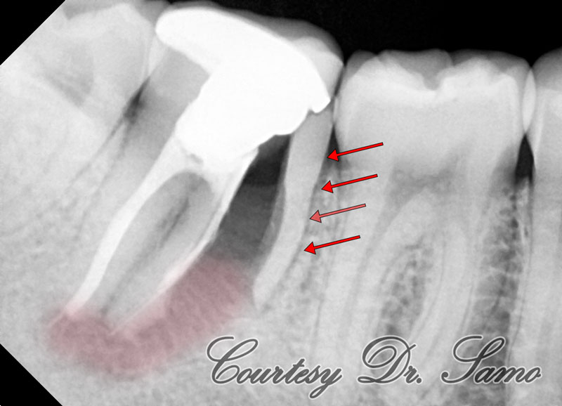Cracked tooth syndrome treatment in Houston