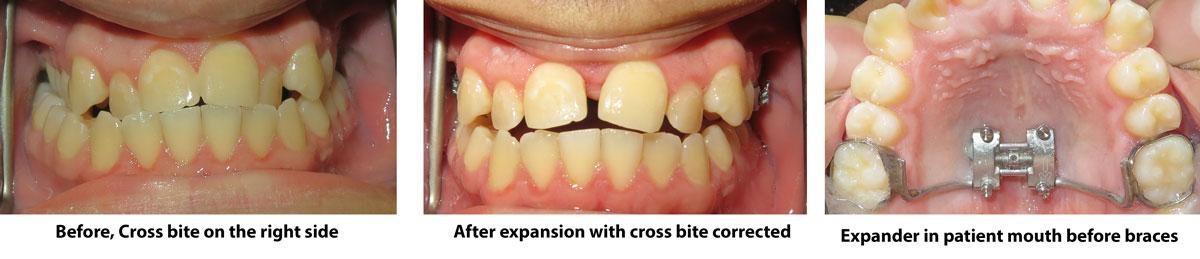 cross bite correction without surgery