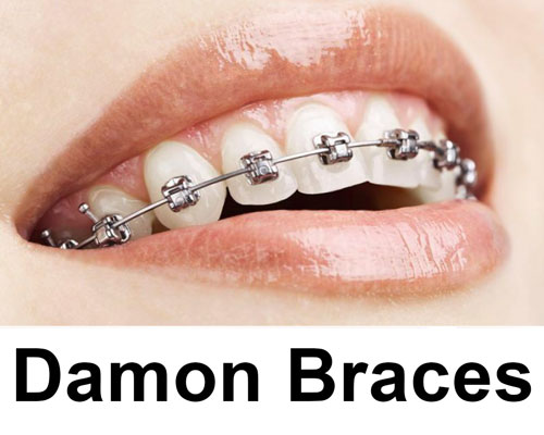 Damon Braces