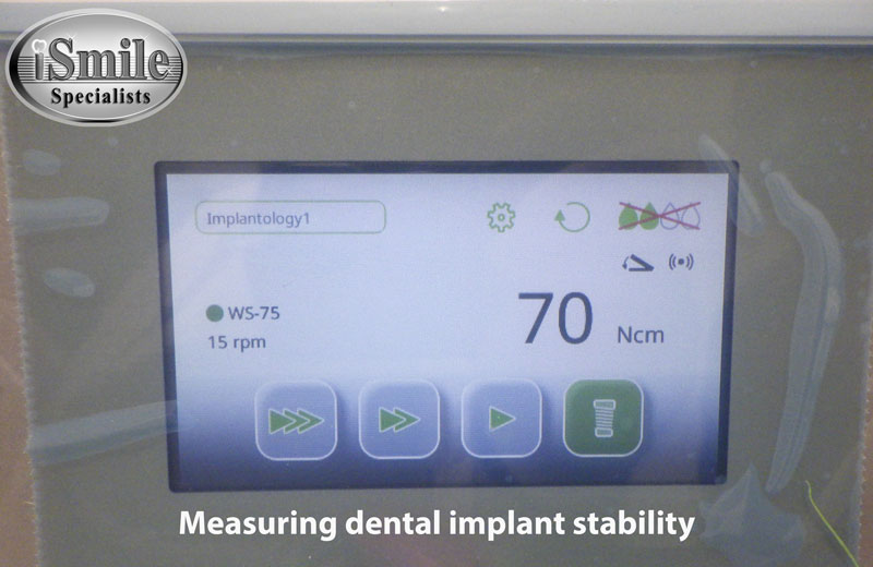 Dental implant Houston