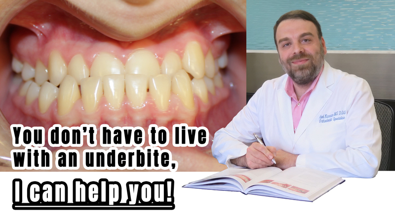 underbite correction with Invisalign Houston