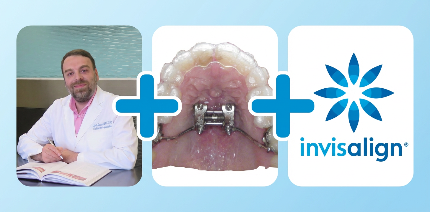 MSE MARPE with Invisalign 