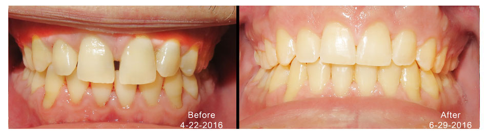 Accelerated space closure with braces