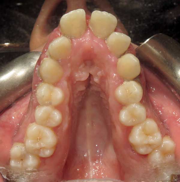 An extreme Narrow Maxilla that was treated with with a Safety release orthodontic skeletal expander using mini implants