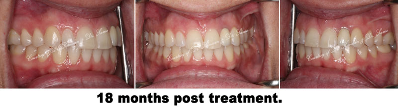 Orthodontic midline correction 