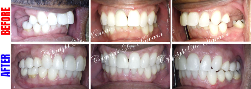 Overbite correction Houston adult patient