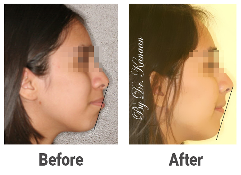 before and after full face correction