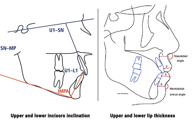 Cephalometric analysis for protruded teeth correction