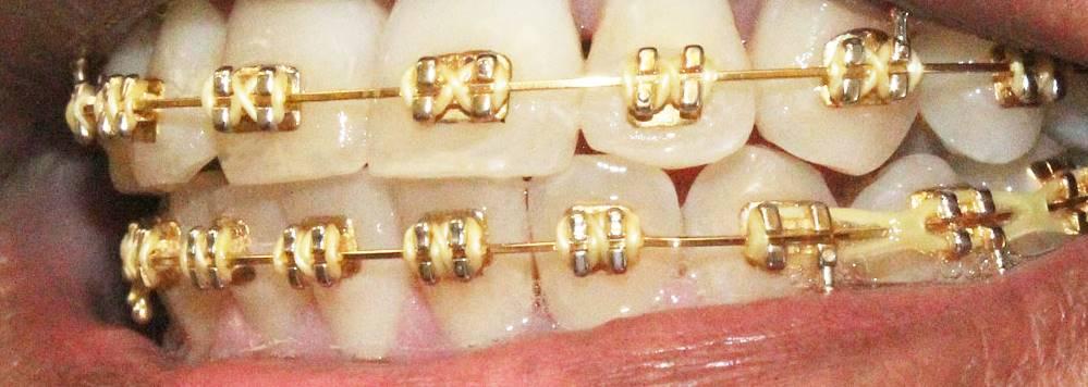 Gold braces in action Sugar Land 