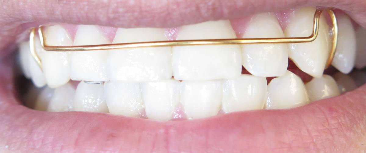 Gold hawley retainer in Sugar Land Houston