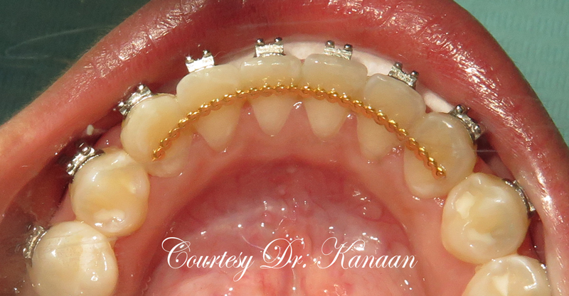 Gold Permanent retainer