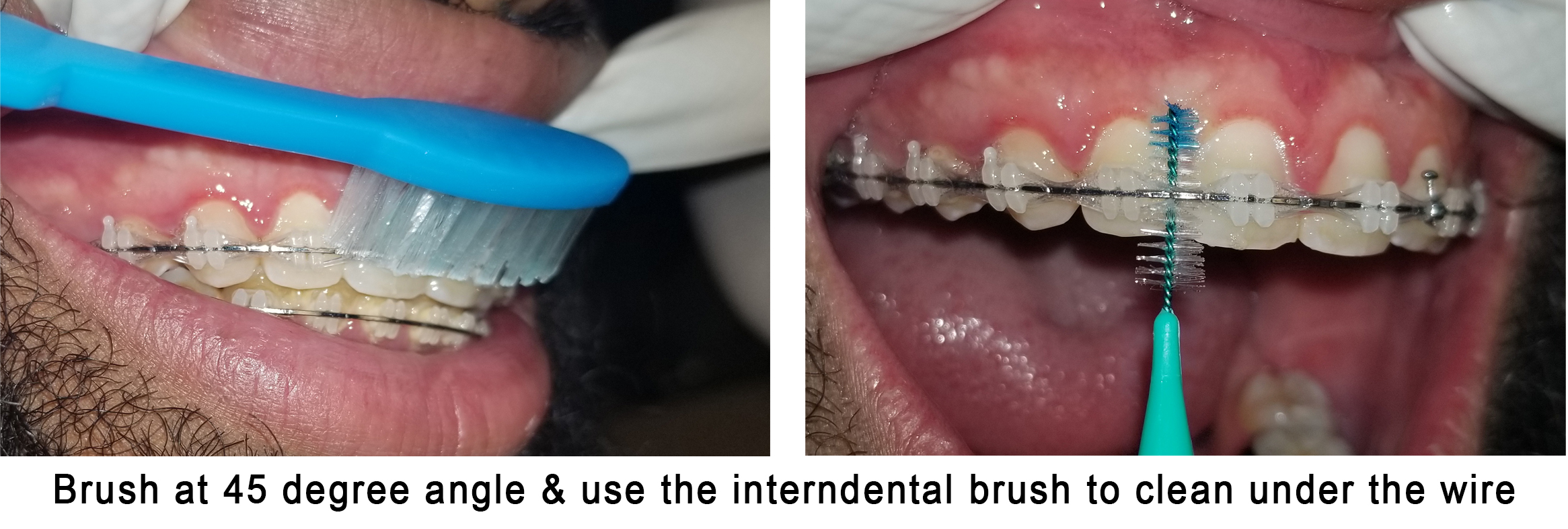 How%20to%20brush%20with%20braces2