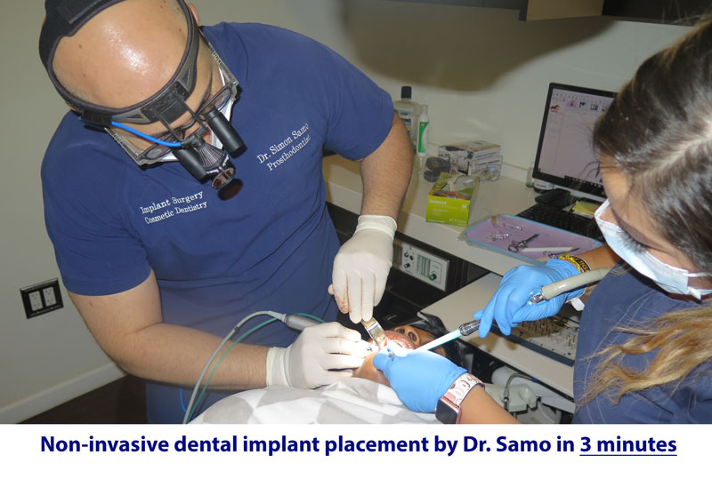 Dental Implant Houston