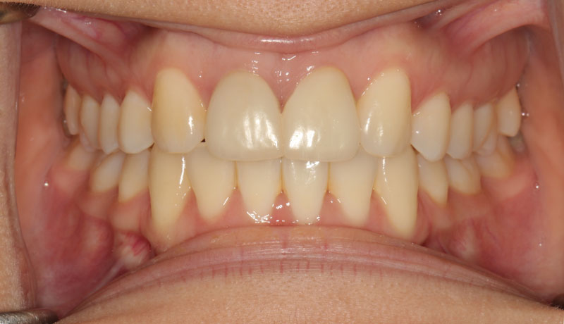 upper incisor extraction orthodontic case