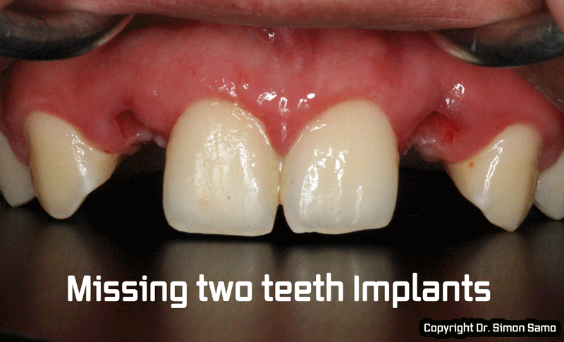 dental implant correction