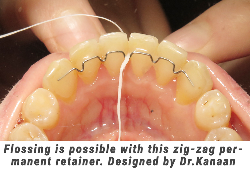 Flossing with Zig Zag permanent retainer