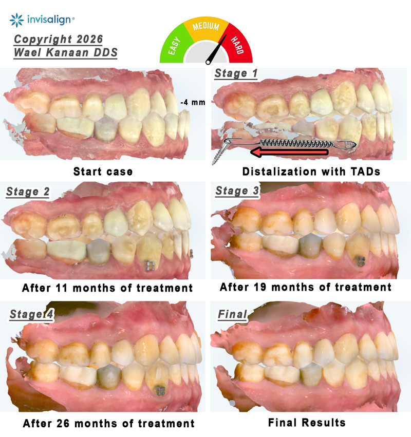 Before and After Invisalign underbite correction in Houston 