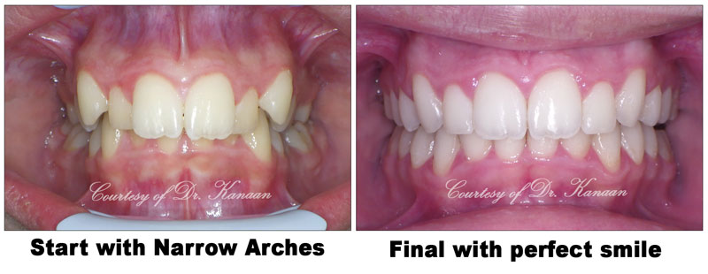 MSE expansion houston orthodontist