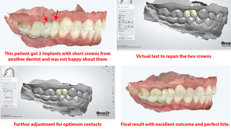 dental implant correction