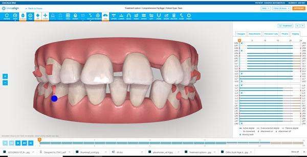 3-D Image Invisalign