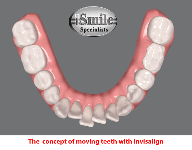 Invisalign Houston