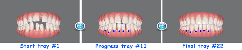 Open bite correction with Invisalign in Houston Sugar Land