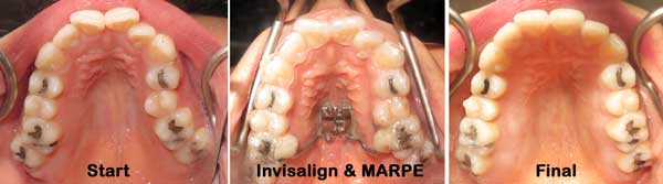 Invisalign and TADs supported RPE Kanaan Houston Sugar Land