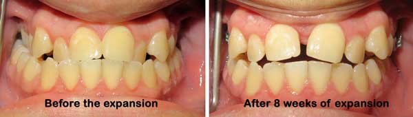 Houston Miniscrew-Assisted Rapid Palatal Expansion technique (MARPE) 1