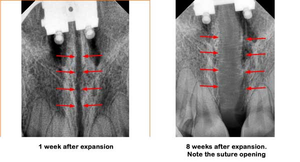 occlusal view of SME suture opening Kanaan Houston