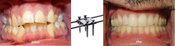 Houston Miniscrew-Assisted Rapid Palatal Expansion technique (MARPE)