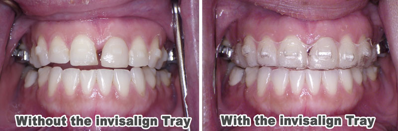 Close up of 2 before and after images one showing before the Invisalign Tray and with the invisalign Tray