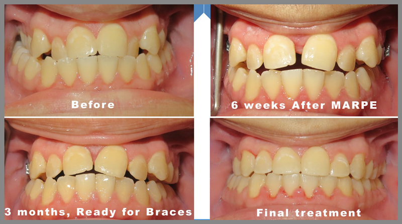 cross bite treated with MARPE. Dr. Kanaan iSmile Specialists