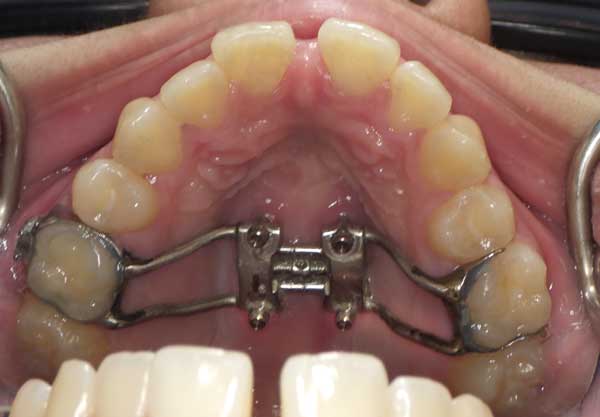 Surgical Maxillary Expander with 4 mini impants TADs Houston Sugar Land Tx