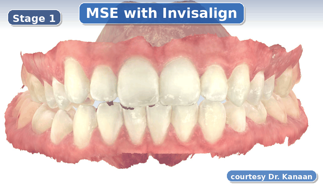 MSE with Invisalign in Houston