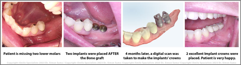 Dental implant case missing two mollars