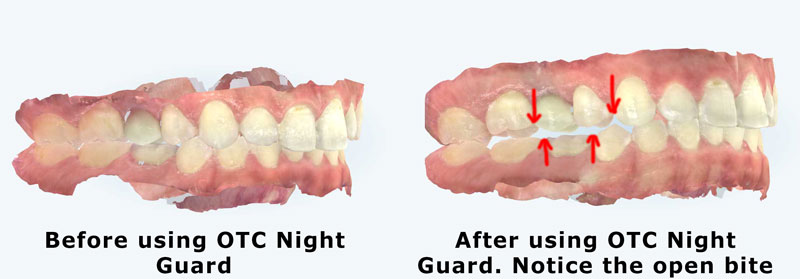 Open bite as a bad side effect of over the counter night guardrd