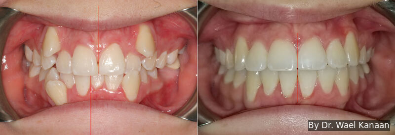Teeth off center correction in Houston Kanaan Orthodontist