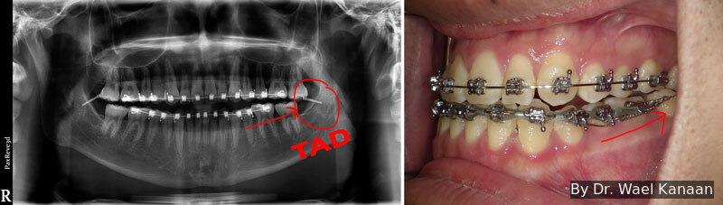 Teeth off center correction with TAD in Houston Kanaan Orthodontist