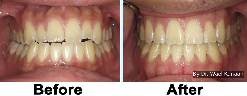 midline correction with TADs