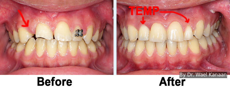 Teeth off center correction in Houston Kanaan Orthodontist