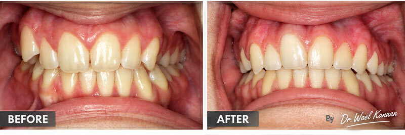 Midline discrepancy caused by a narrow Maxilla