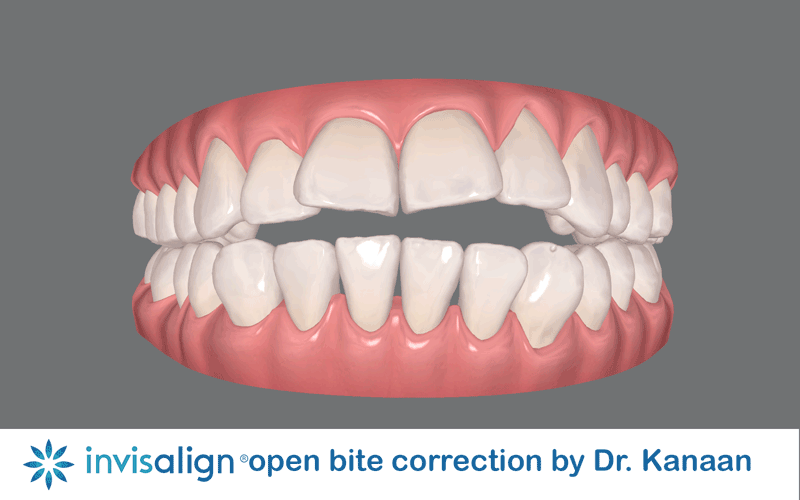 Open bite correction with Invisalign in Houston Sugar Land