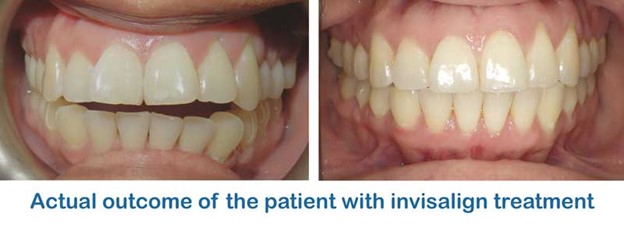 invisalign open bite correction before and after