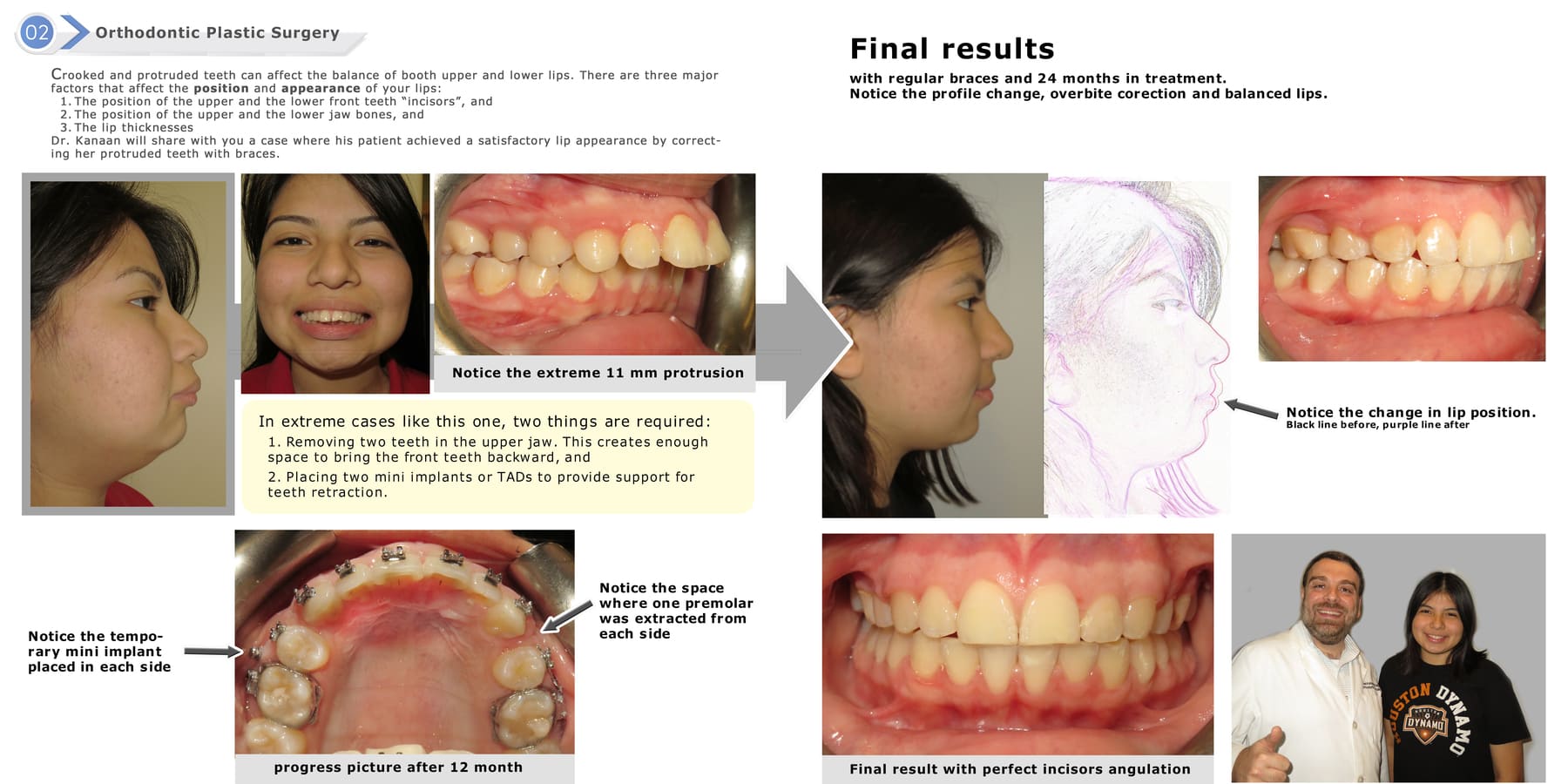 Orthodontic Plastic Surgery Case with Dr. Kanaan