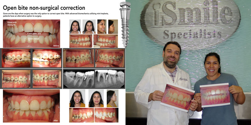 Dr. Kanaan and patient who received severe open bite without surgery using mini implants.
