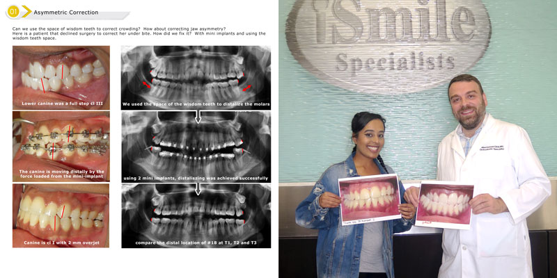 Undrbite correction without surgery