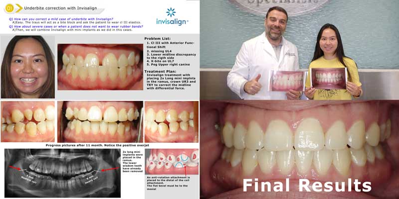 Invisalign with TADs to correct underbite