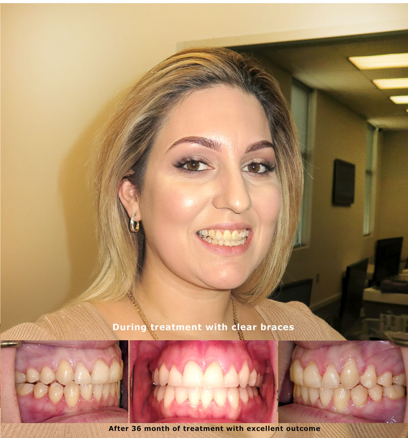 Open bite treatment without surgey in Sugar Land using TADs mini implants