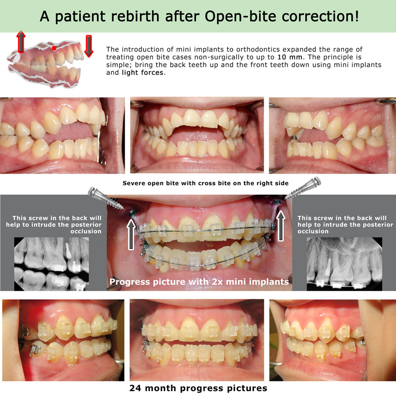 Open bite treatment without surgey in Houston using TADs mini implants