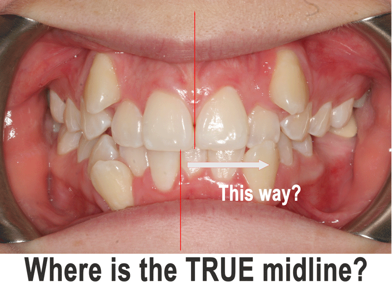 midline correction dental vs surgical 